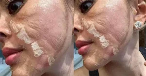 Cách chăm sóc da sau khi peel hạn chế gây mỏng da