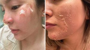 Lưu ý trước khi lựa chọn peel da