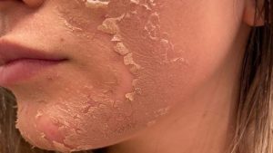 Sau khi peel da bao lâu thì bong