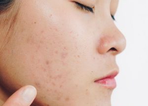 Lưu ý cách skincare sau khi đốt tàn nhang