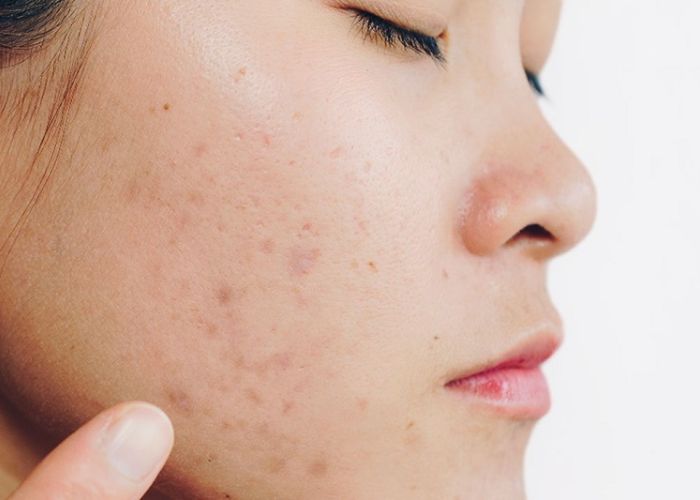 Lưu ý cách skincare sau khi đốt tàn nhang