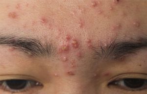 Dùng kem chống nắng có làm nổi mụn thêm không