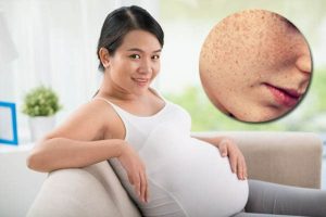 Mẹ bầu bị thâm nám phải làm sao