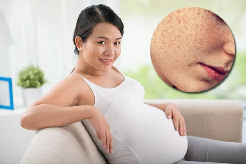 Mẹ bầu bị thâm nám phải làm sao