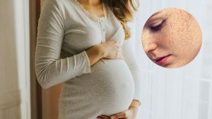 Những rủi ro khi mẹ bầu dùng mỹ phẩm hóa học để trị thâm nám